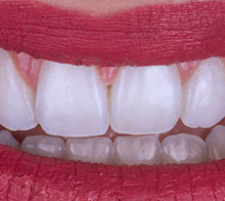 Whitening AFTER 600